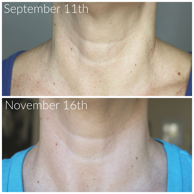 NuFACE before & after pics after 60 days!