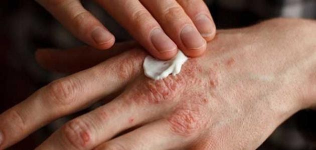 علاجات طبية ومنزلية للأكزيما