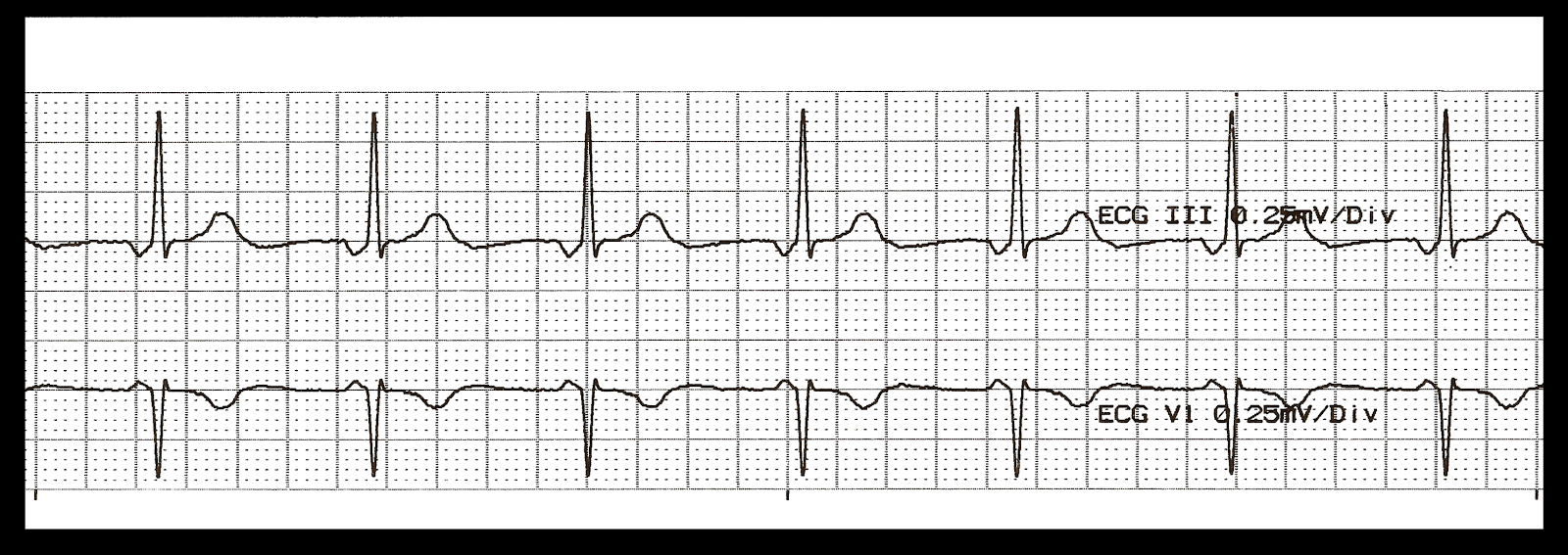 Various Accelerated Junctional Rhythms