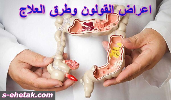 اعراض القولون وطرق العلاج