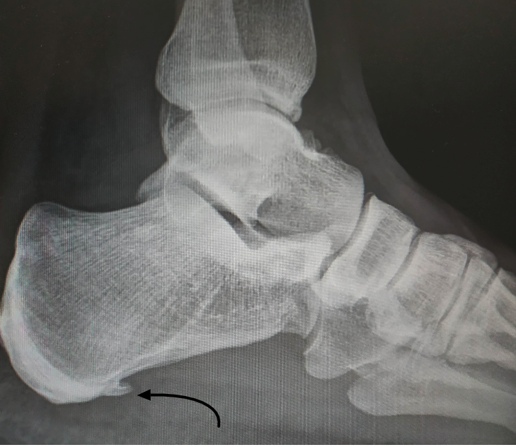 How I coped with Plantar Fasciitis