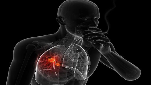 إحصائيات حول سرطان الرئة إحصائيات حول سرطان الرئة