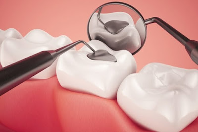 Trám răng là gì? Có những loại trám răng nào? 2