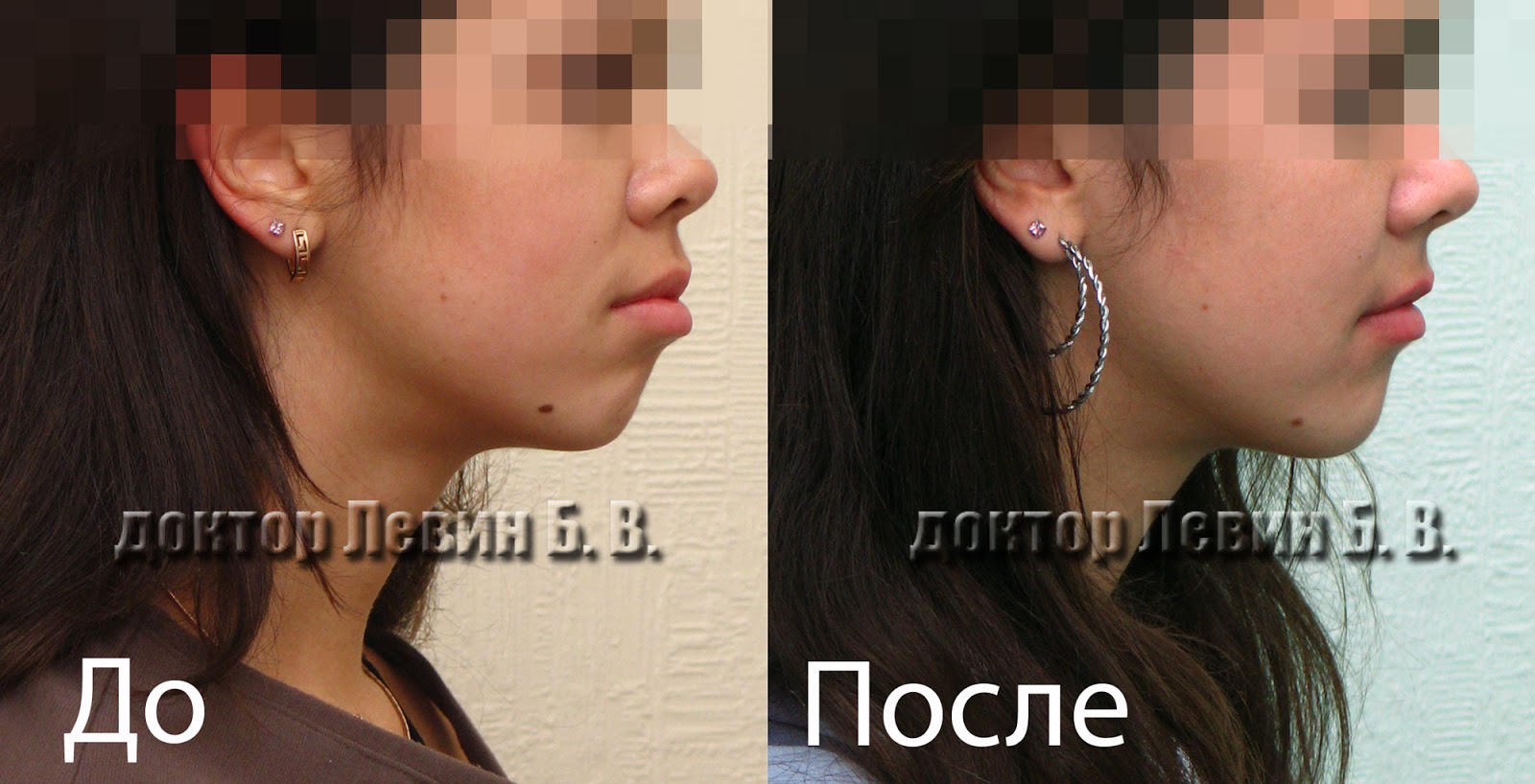 изменение лица после удаления зубов мудрости. лицо после удаления зубов мудрости. операция по исправлению прикуса. меняется ли лицо после удаления зуба мудрости. меняется ли лицо после удаления зуба мудрости.