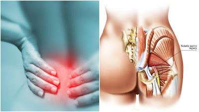 11 Remedies For Sciatic Pain You Desperately Need To Try Before Popping Another Painkiller 11 Remedies For Sciatic Pain You Desperately Need To Try Before Popping Another Painkiller
