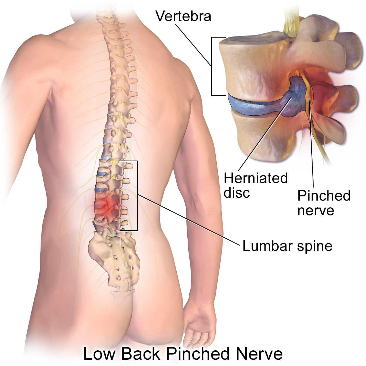 What is the recovery period after slip disc or herniated disc surgery