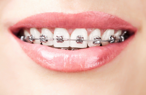  metal braces