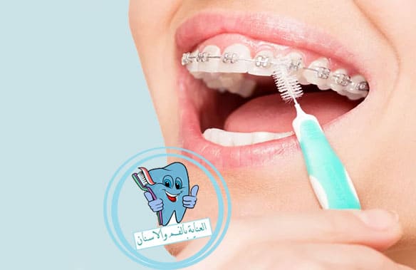 فرشاة التقويم وكيفية تنظيف الاسنان بها
