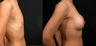 Augmentation mammaire pour Femme marié  avant et après