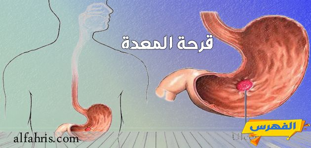 اعراض قرحة الاثنى عشر