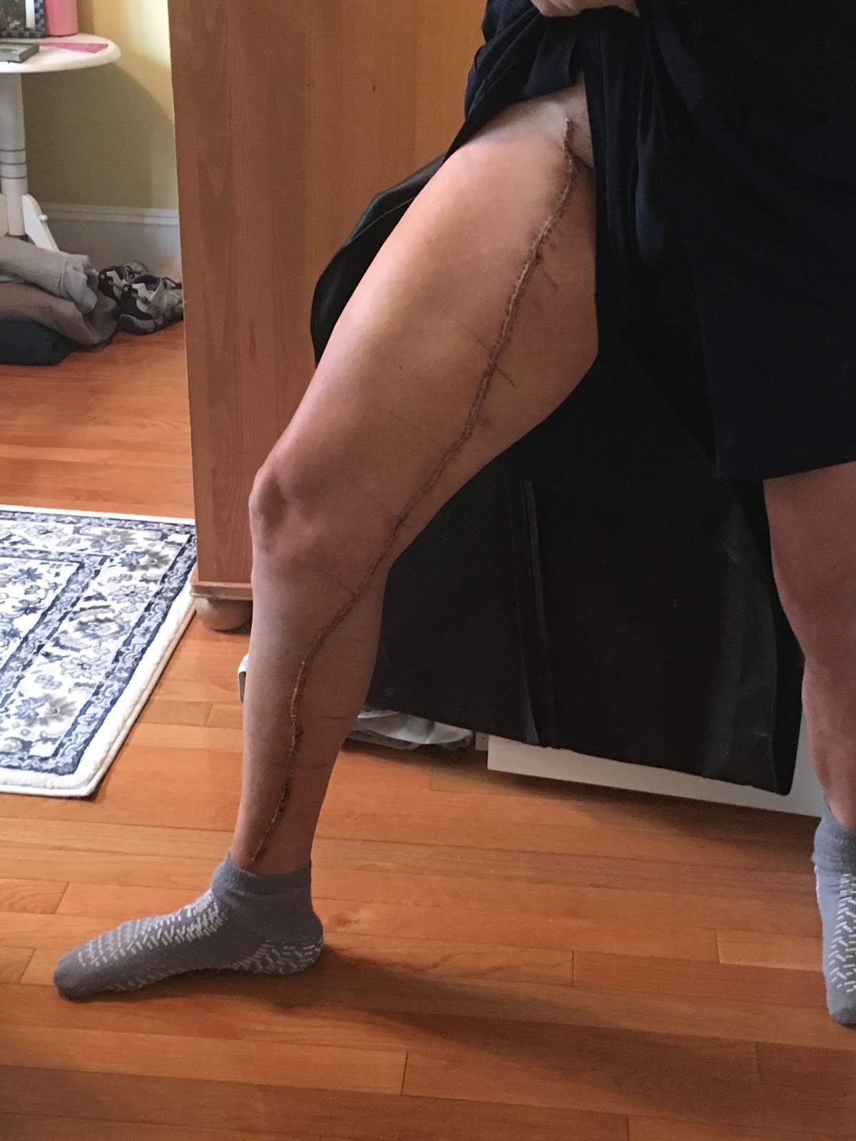 Post-Op Leg