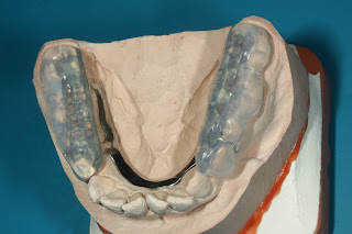 Zahnarzt Bochum, Craniomandibulären Dysfunktion