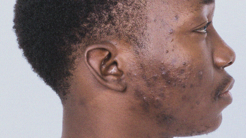 Natural Ways To Remove Dark Spots