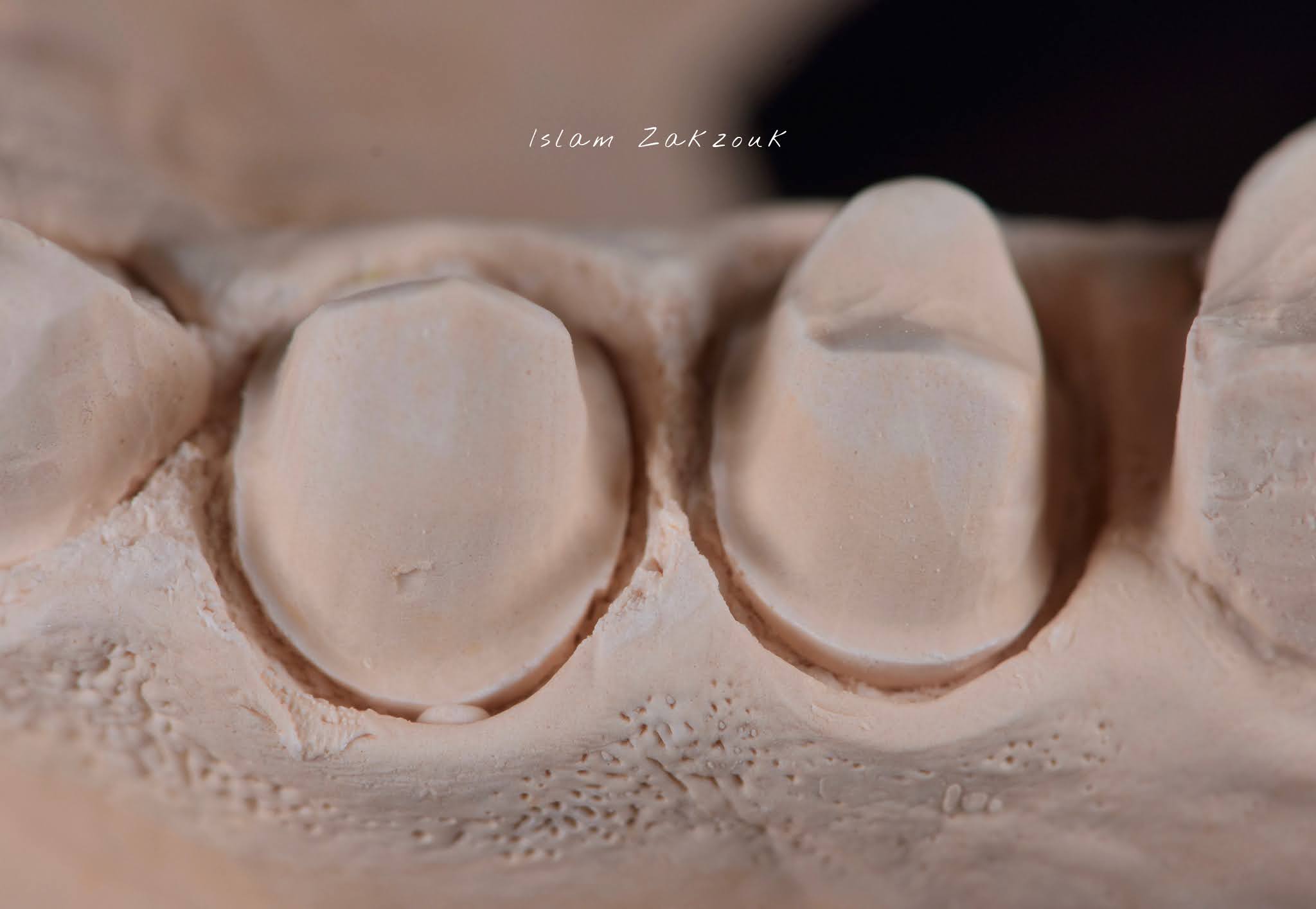 Retraction cords.. Why? When? How? Dental Esthetics