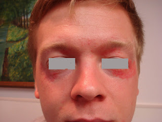 Eyelid dermatitis steroid