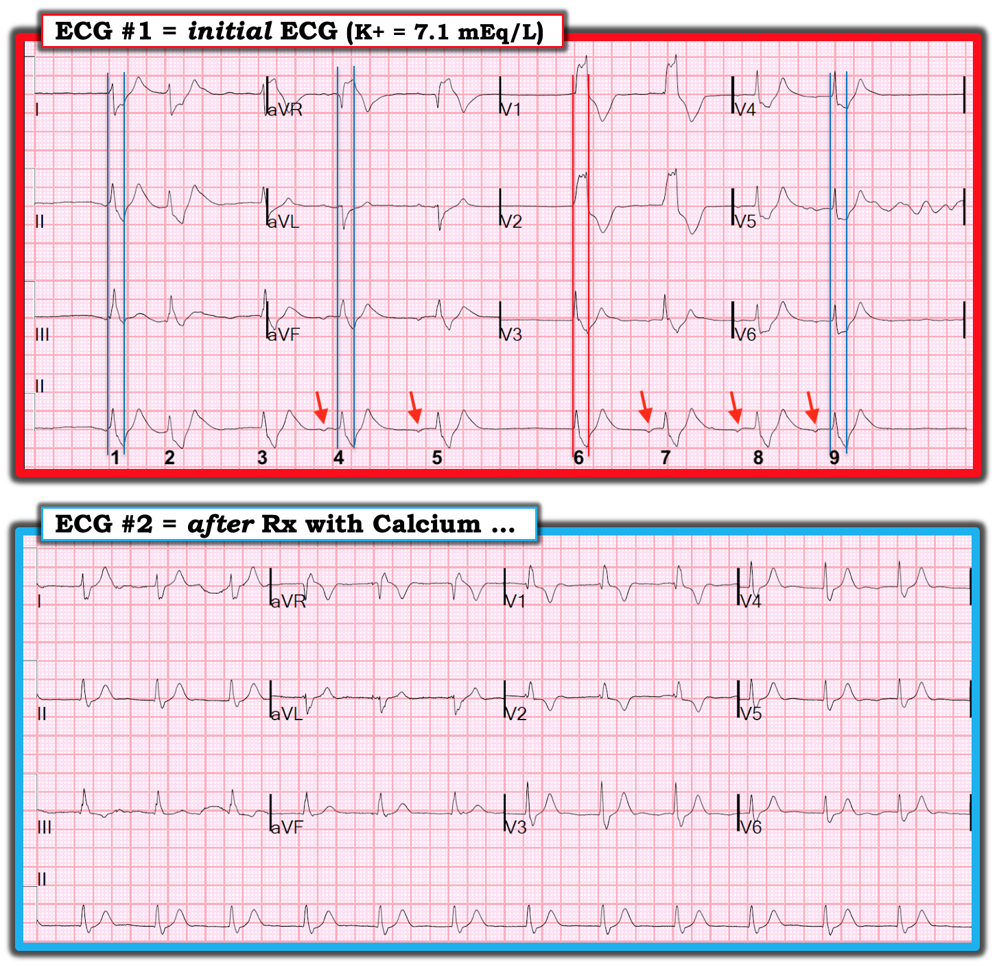 Dr. Smith's ECG Blog A patient with cardiac arrest, ROSC, and right