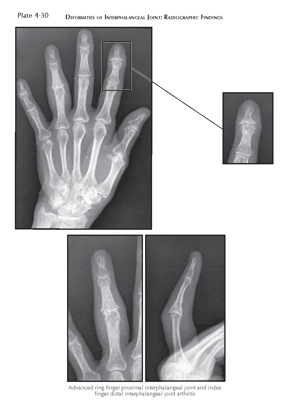 DEFORMITIES OF INTERPHALANGEAL JOINT pediagenosis