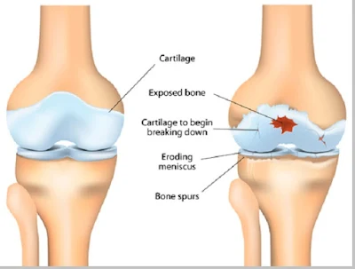 Osteoathritis (penurunan fungsi tulang persendian) - berbagaireviews.com