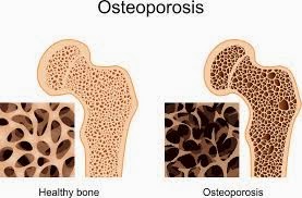 Obat Osteoporosis Tradisional