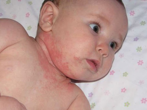 Penyebab Alergi Pada Anak