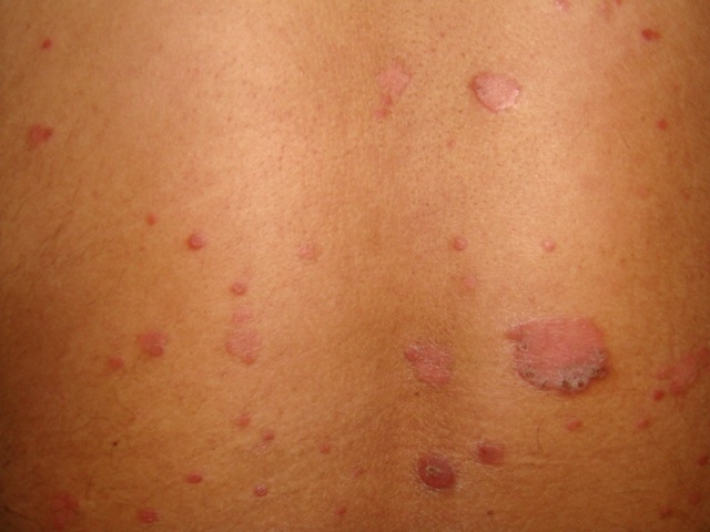 Psoriasis - Treatment - NHS Choices