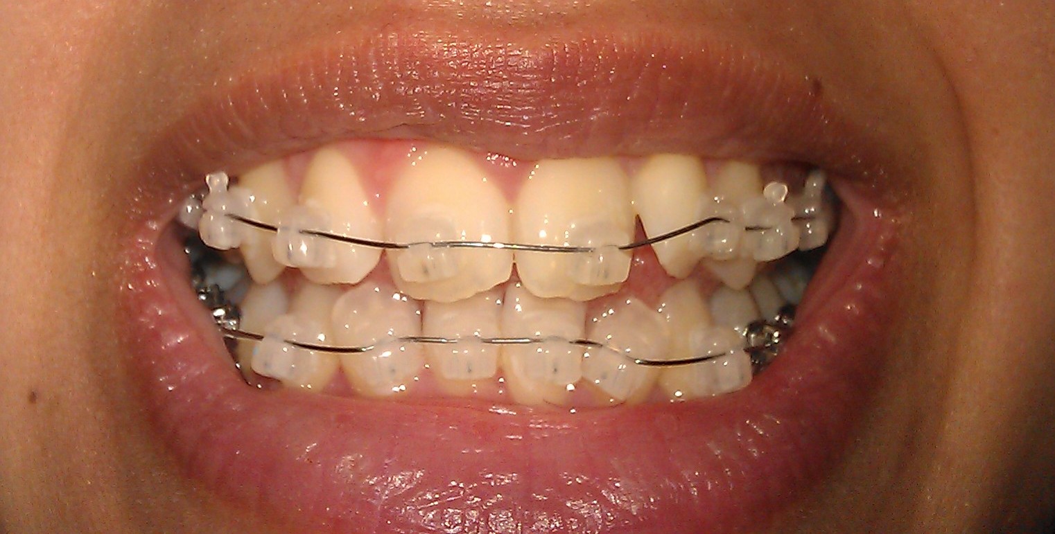 My Damon Clear Braces April 2013