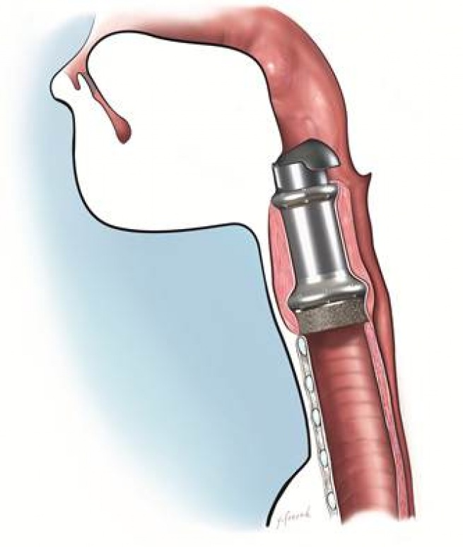 The Artificial Larynx