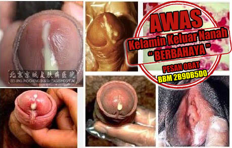 Akibat Kelamin Keluar Nanah Akibat Kelamin Keluar Nanah