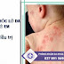 Bệnh chốc lở da ở trẻ em và cách điều trị hiệu quả