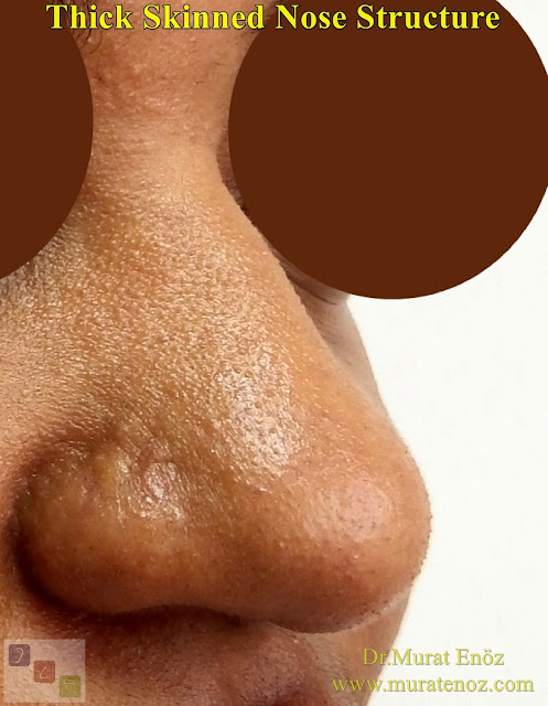Thick Skinned Nose Structure Thick Skinned Nose Structure