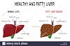 Fatty Liver Detox