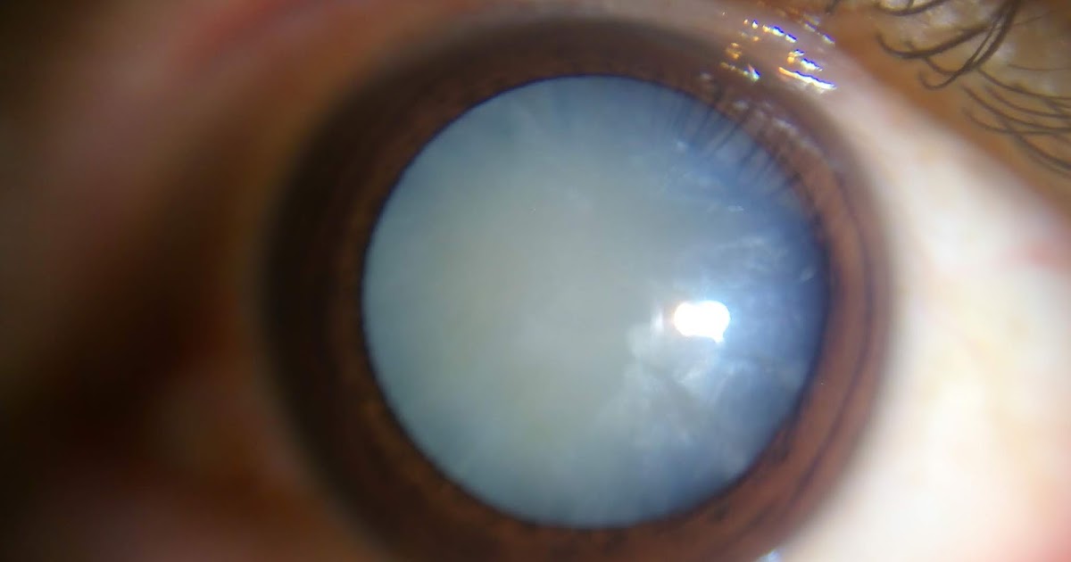 Cataracts Symptoms Types Causes and Treatment