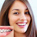 Tìm hiểu niềng răng sứ bạn nên nắm rõ những ưu và nhược điểm