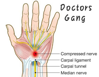 File of carpal tunnel syndrome provided by doctors gang Carpal tunnel syndrome