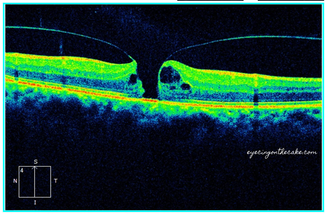 oct macular test oct macular test