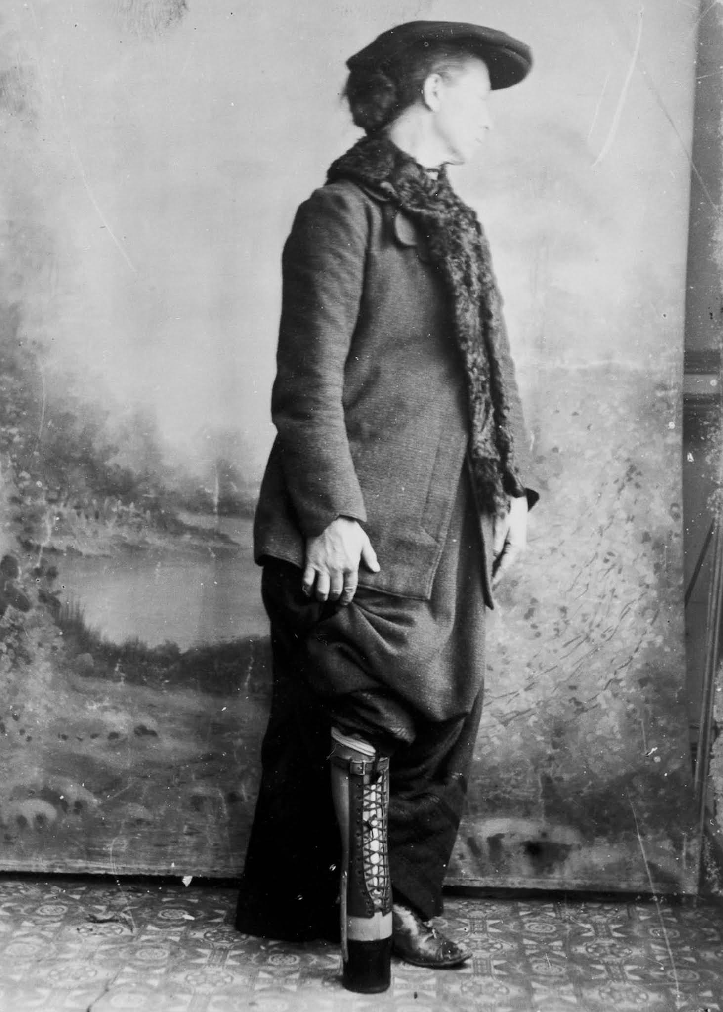 The extraordinary early prostheses made by James Gillingham  1900 - 20