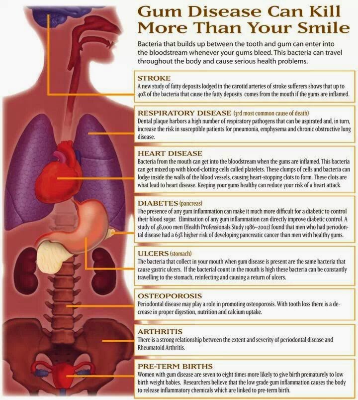 Gum Disease Can Kill More Than Your Smile