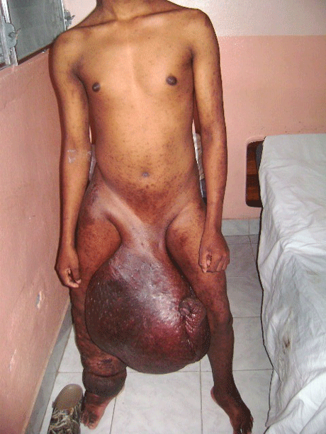 Biggest Recorded Human Penis 26