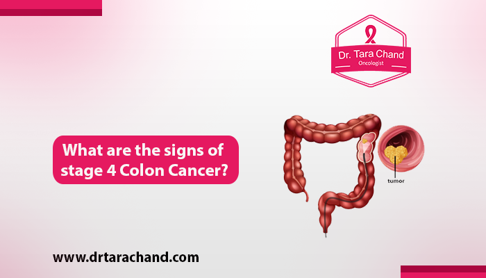 What are the signs of stage 4 colon cancer 2022?
