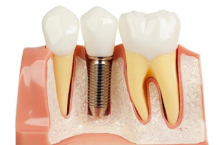 Các bước có trong quy trình trồng răng implant
