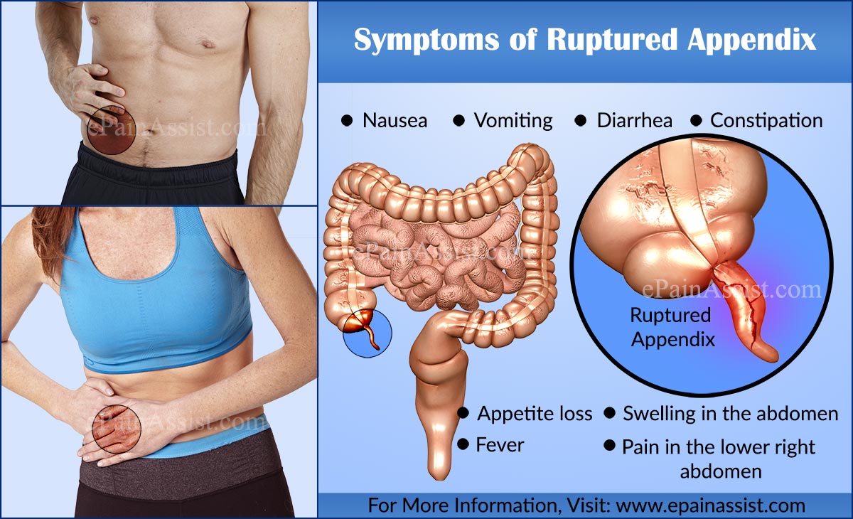 Como reducir la distensión abdominal