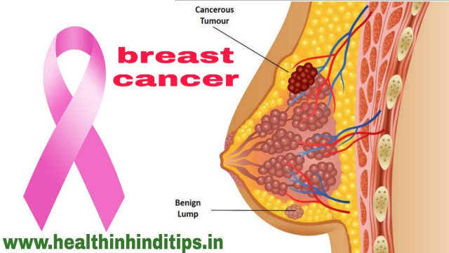 breast cancer के लक्षण, इलाज और रोकने के उपाय
