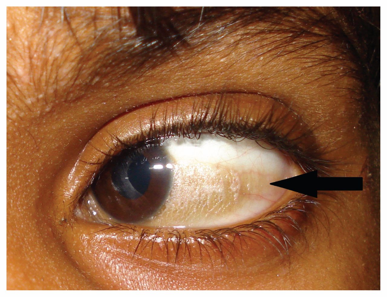 Causes and treatment of Xerosis of conjunctiva
