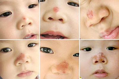 Impetigo Symptoms and causes - Mayo Clinic