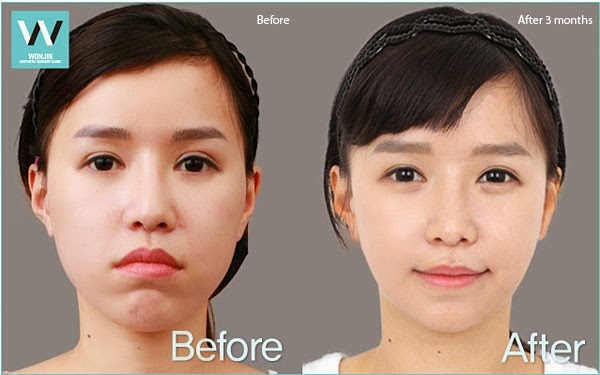 protruding lips before surgery lip jaw