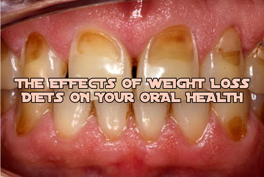 ORAL HEALTH The Effects of Weight Loss Diets OdontoFarma