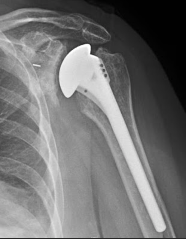 Shoulder Arthritis / Rotator Cuff Tears / Shoulder Pain Stemless