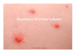 kaşıntısız lekeler nasıl geçer