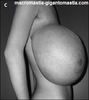 Gigantomastia Mature Gigantomastia Mature