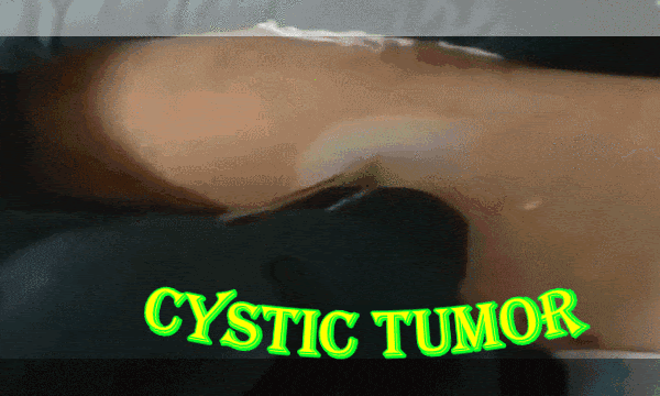 Treatment of cystic tumor
